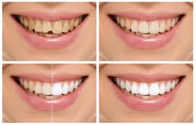 Snowhite Teeth Whitening – účinky – jak používat – kapky