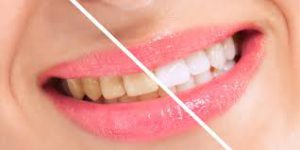 Snowhite Teeth Whitening - bělení zubů – akční – složení – cena